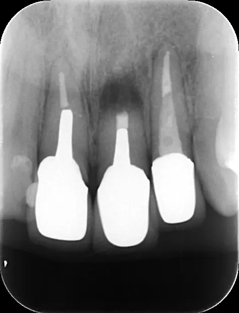 外科的歯内療法（歯根端切除術・意図的再植） | 【根管治療専門サイト
