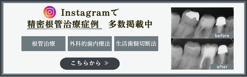Instagramで精密根管治療症例 多数掲載中