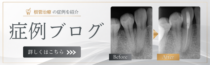 Instagramで精密根管治療症例 多数掲載中